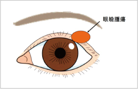 1.眼瞼腫瘍（まぶたの腫瘍）