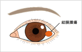 2.結膜の腫瘍（しろめの腫瘍）