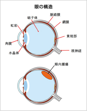 3.眼内腫瘍（眼の中の腫瘍）