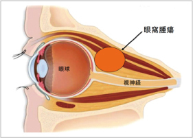 4.眼窩腫瘍（眼の後ろの腫瘍）